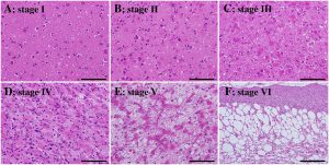 Can mRNA-based COVID-19 vaccines cause prion disease or Alzheimer&rsquo;s?  Science-Based Medicine